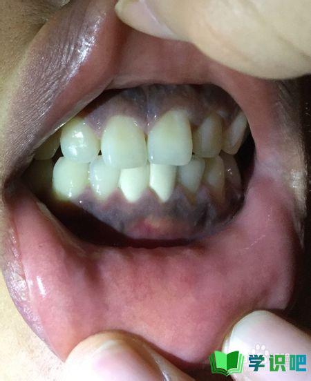 牙龈发综色如何恢复正常？ 第2张