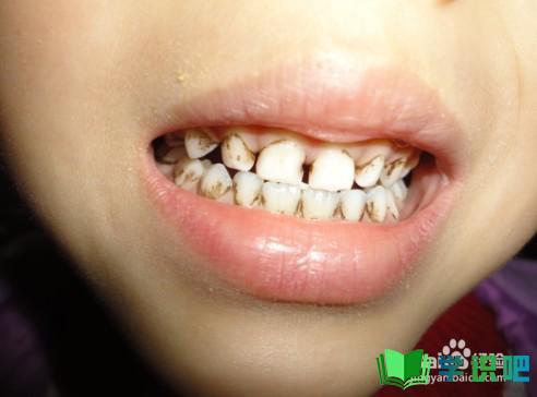 牙龈发综色如何恢复正常？ 第3张