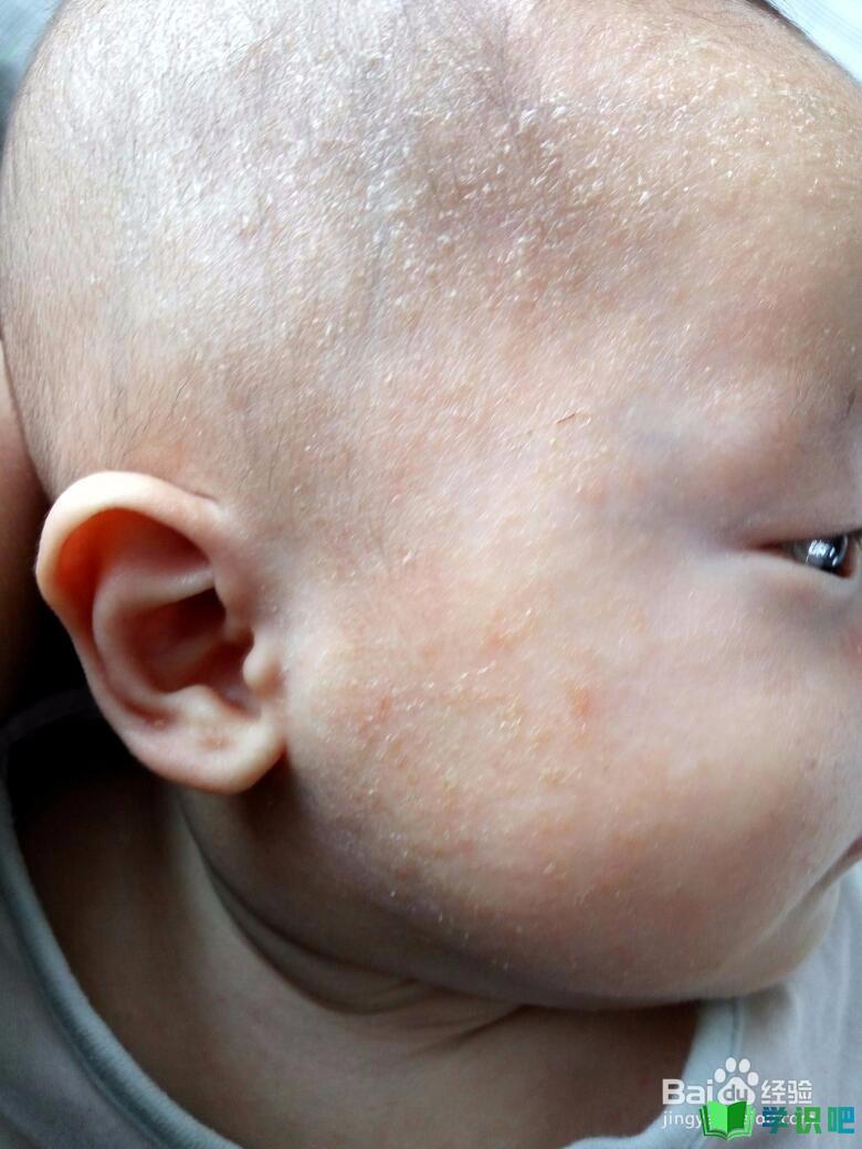 宝宝湿疹头皮有湿疹怎么办？
