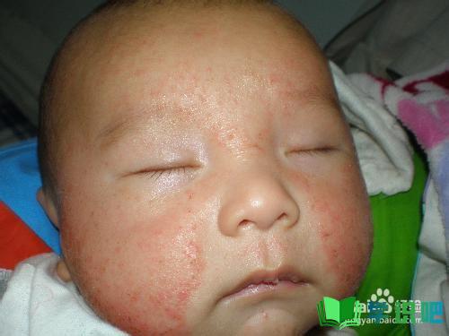 宝宝湿疹严重怎么办？