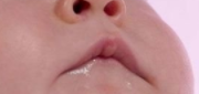婴儿嘴唇干裂怎么办？ 第2张