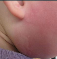 婴儿得了湿疹怎么办？