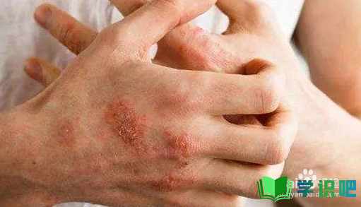 皮肤瘙痒应该怎么办？