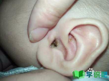 宝宝耳朵里面的耳屎很多很硬怎么办？