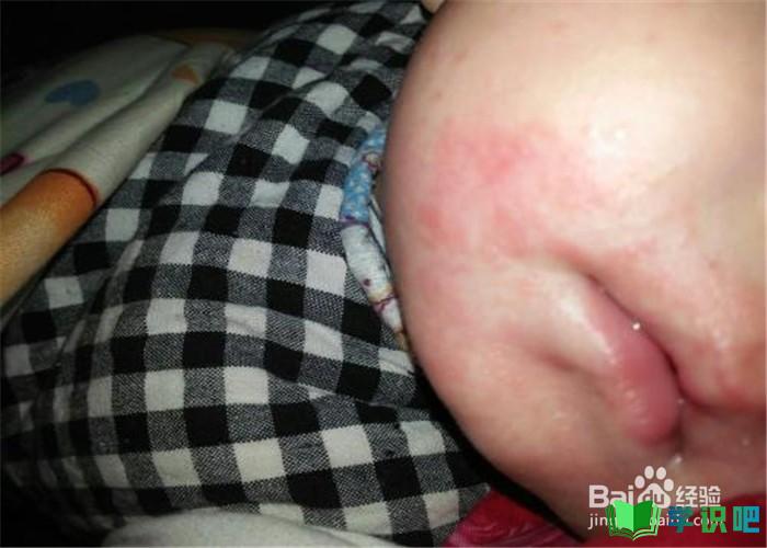 孩子6岁了湿疹还很严重怎么办？ 第1张