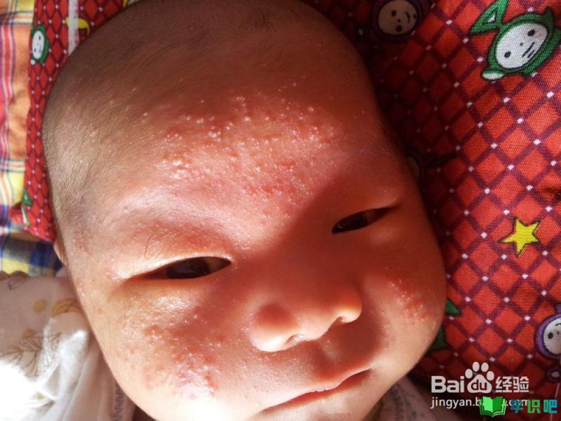 宝宝脸上起湿疹怎么办？ 第6张