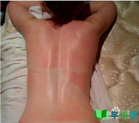 皮肤被太阳晒红怎么办？